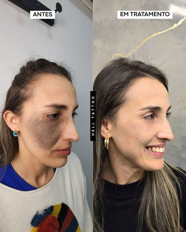 559569c5 0381 48cb 8292 b5b5cb8198e1 Nevo de Ota pode ser tratado com laser, explica biomédico