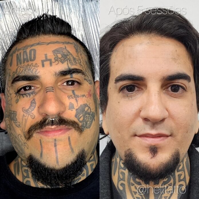 Remoção de tatuagem cresce e muda perfil de quem procura